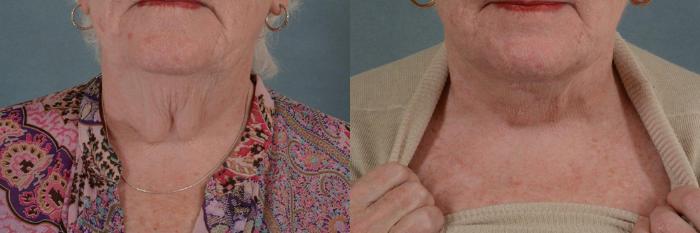 Before & After Neck Lift Case 241 View #1 View in Tallahassee, FL