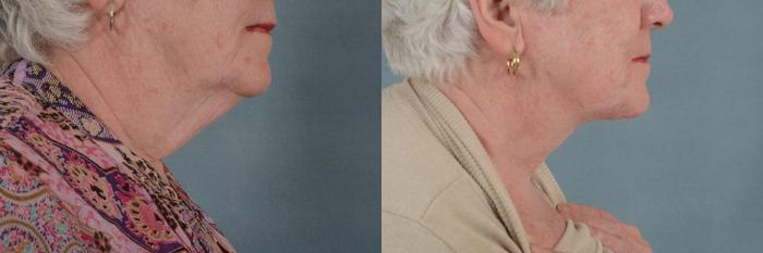 Before & After Neck Lift Case 241 View #2 View in Tallahassee, FL
