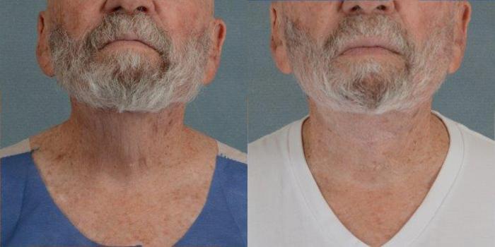 Before & After Neck Lift Case 242 View #1 View in Tallahassee, FL
