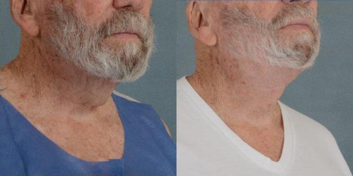 Before & After Neck Lift Case 242 View #2 View in Tallahassee, FL