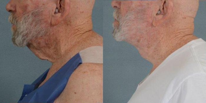 Before & After Neck Lift Case 242 View #3 View in Tallahassee, FL