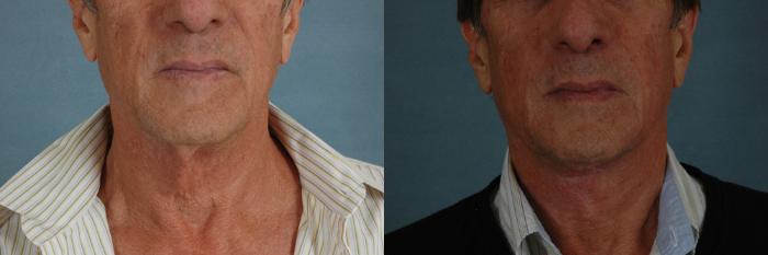 Before & After Neck Lift Case 243 View #1 View in Tallahassee, FL