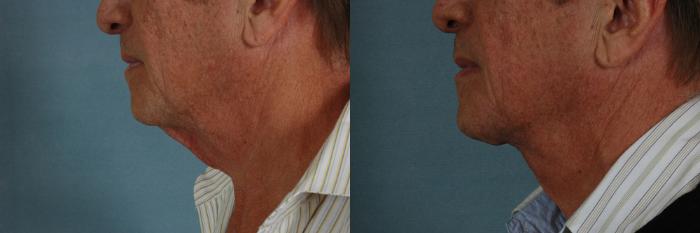 Before & After Neck Lift Case 243 View #2 View in Tallahassee, FL