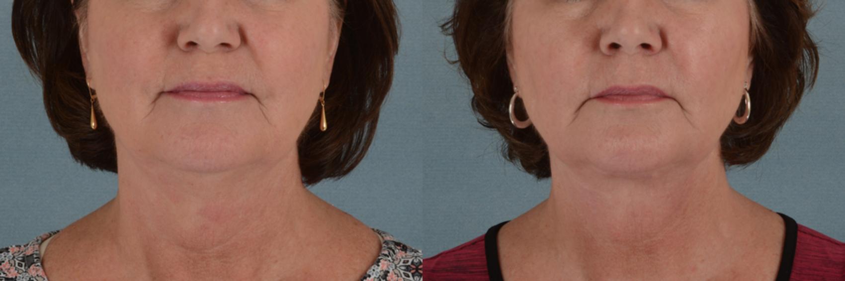 Before & After Neck Lift Case 244 View #1 View in Tallahassee, FL
