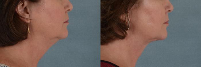 Before & After Neck Lift Case 244 View #2 View in Tallahassee, FL