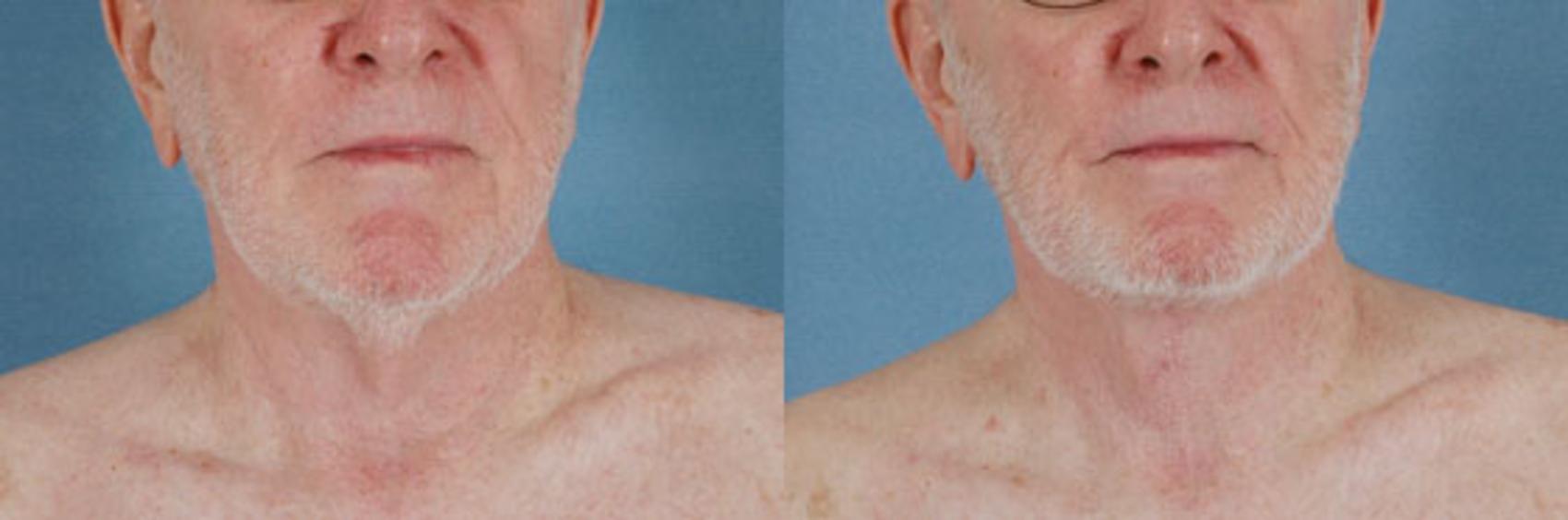 Before & After Neck Lift Case 247 View #1 View in Tallahassee, FL