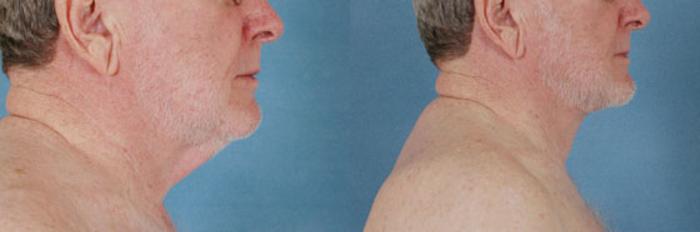 Before & After Neck Lift Case 247 View #2 View in Tallahassee, FL