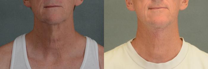 Before & After Neck Lift Case 341 View #1 View in Tallahassee, FL