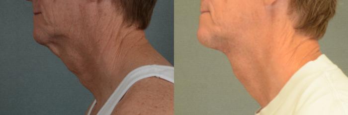 Before & After Neck Lift Case 341 View #2 View in Tallahassee, FL