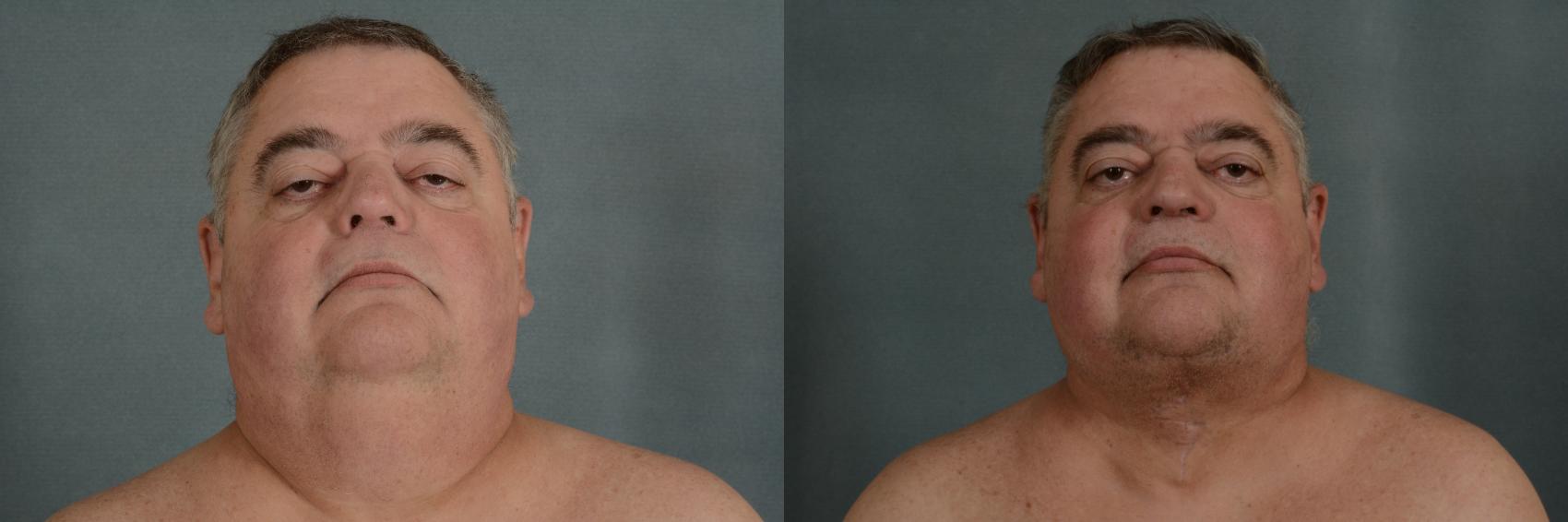 Before & After Neck Lift Case 344 View #1 View in Tallahassee, FL