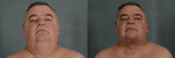 Before & After Neck Lift Case 344 View #1 View in Tallahassee, FL