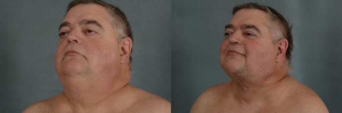 Before & After Neck Lift Case 344 View #2 View in Tallahassee, FL
