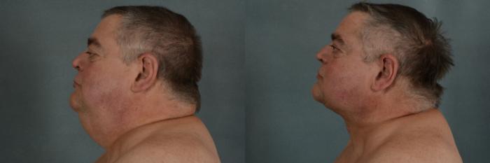 Before & After Neck Lift Case 344 View #3 View in Tallahassee, FL