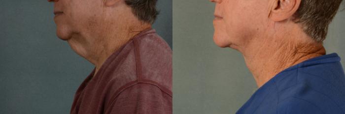 Before & After Neck Lift Case 430 View #2 View in Tallahassee, FL