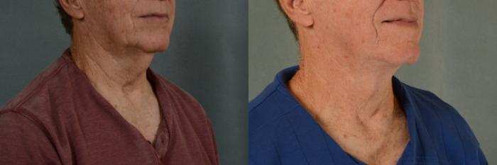 Before & After Neck Lift Case 430 View #3 View in Tallahassee, FL