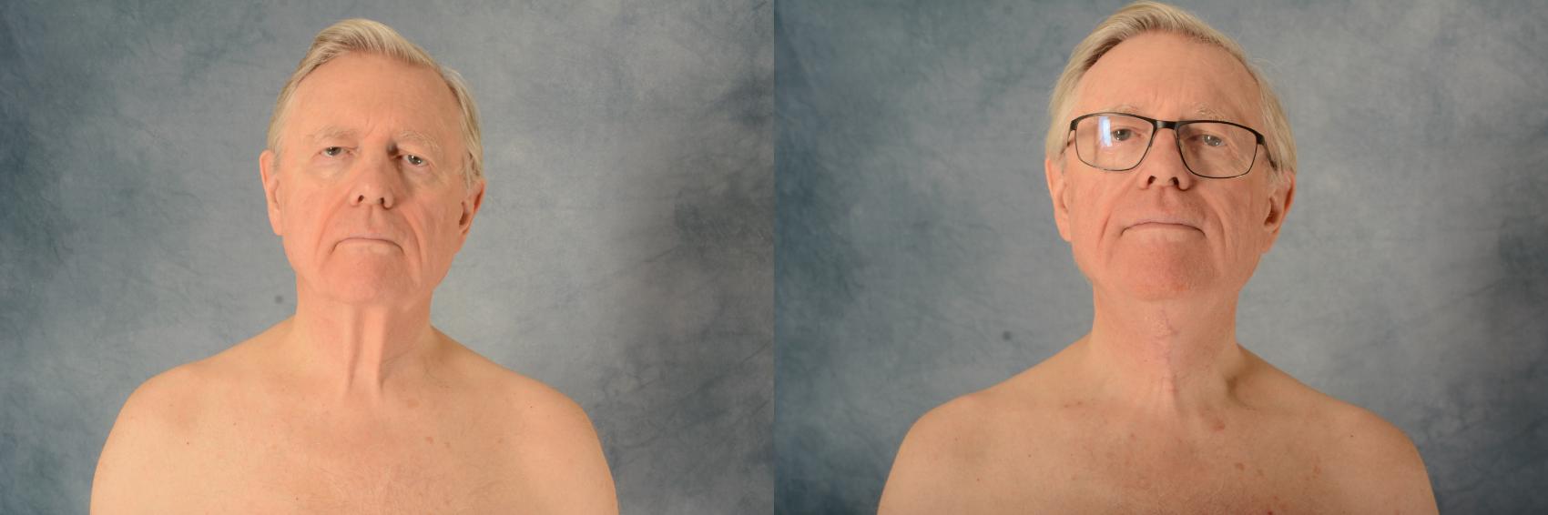 Before & After Neck Lift Case 576 Front View in Tallahassee, FL