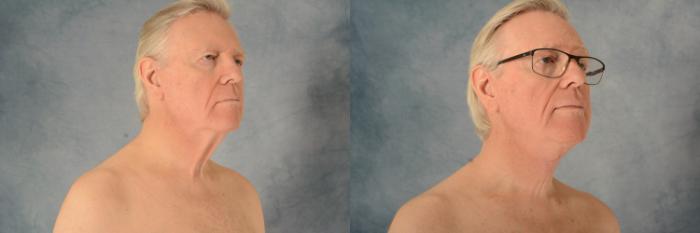 Before & After Neck Lift Case 576 Right Oblique View in Tallahassee, FL