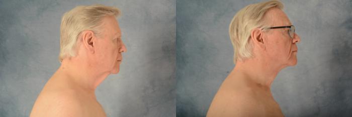 Before & After Neck Lift Case 576 Right Side View in Tallahassee, FL