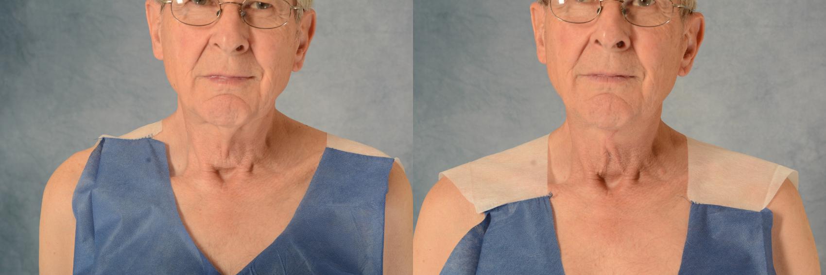 Before & After Neck Lift Case 577 Front View in Tallahassee, FL