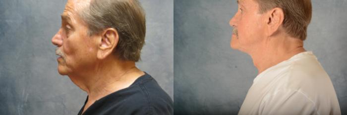 Before & After Neck Lift Case 578 Left Side View in Tallahassee, FL