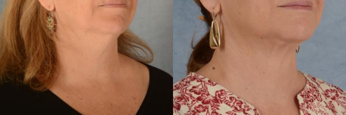 Before & After Neck Lift Case 719 Right Oblique View in Tallahassee, FL