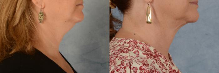 Before & After Neck Lift Case 719 Right Side View in Tallahassee, FL