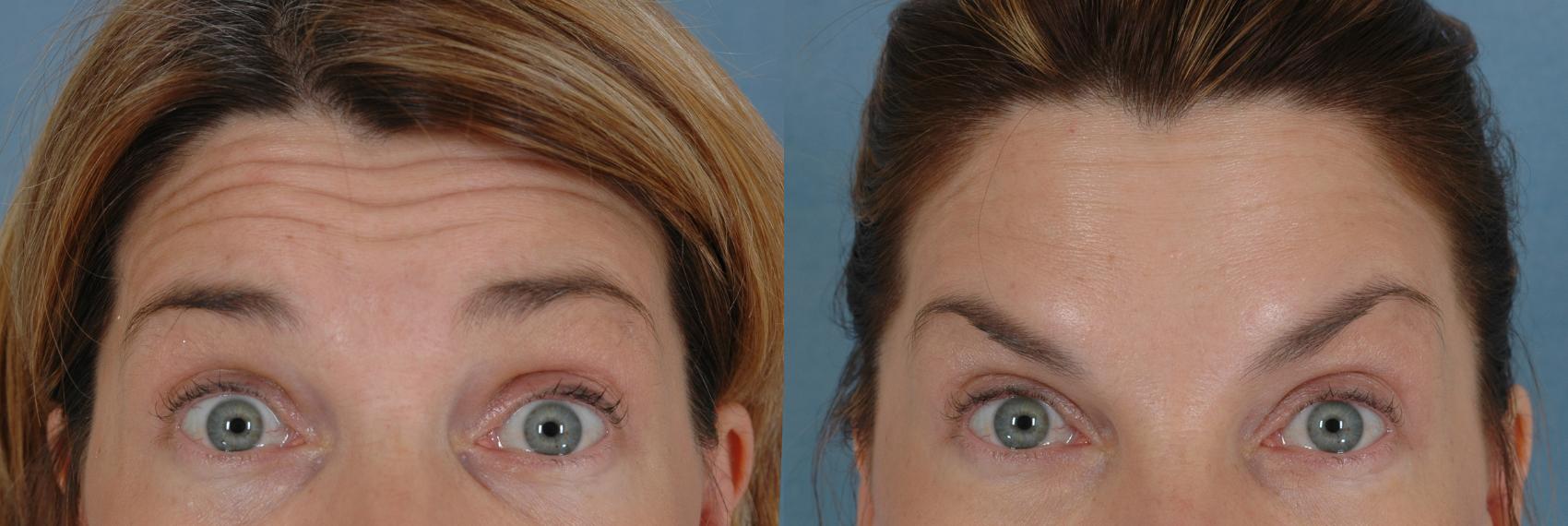 Before & After Neuromodulators Case 250 View #1 View in Tallahassee, FL