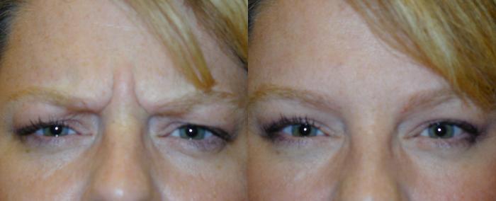 Before & After Neuromodulators Case 252 View #1 View in Tallahassee, FL