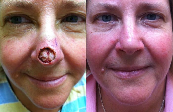 Before & After Nose Reconstruction Case 325 View #1 View in Tallahassee, FL