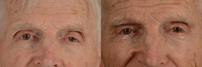 Before & After Oculoplastic Surgery Case 269 View #1 View in Tallahassee, FL