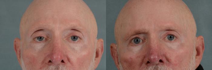 Before & After Oculoplastic Surgery Case 290 View #1 View in Tallahassee, FL
