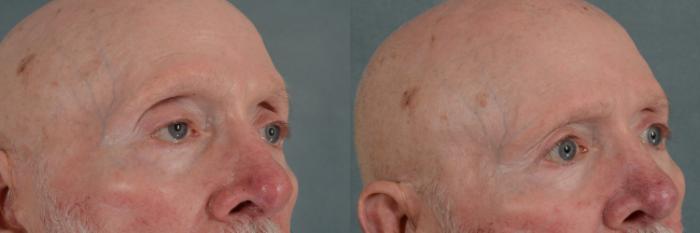 Before & After Oculoplastic Surgery Case 290 View #2 View in Tallahassee, FL