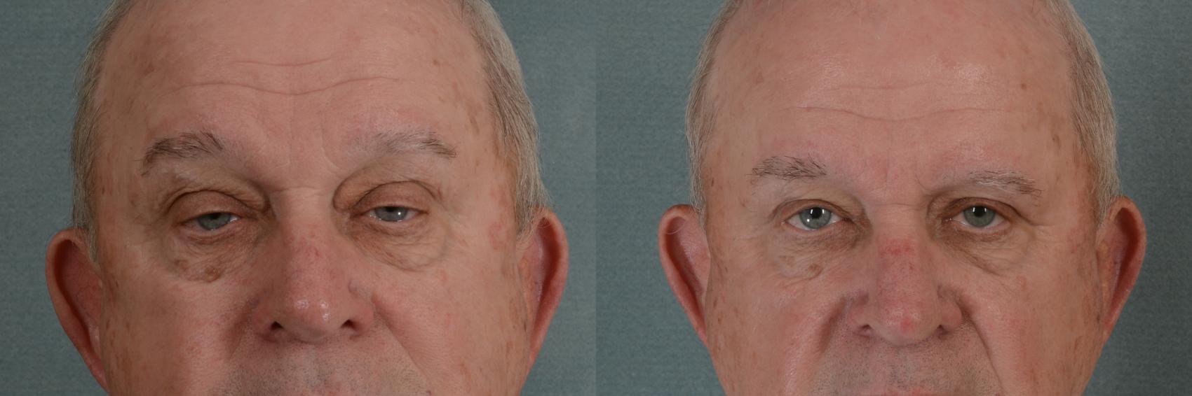 Before & After Oculoplastic Surgery Case 335 View #1 View in Tallahassee, FL