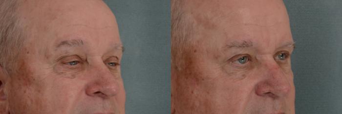 Before & After Oculoplastic Surgery Case 335 View #2 View in Tallahassee, FL