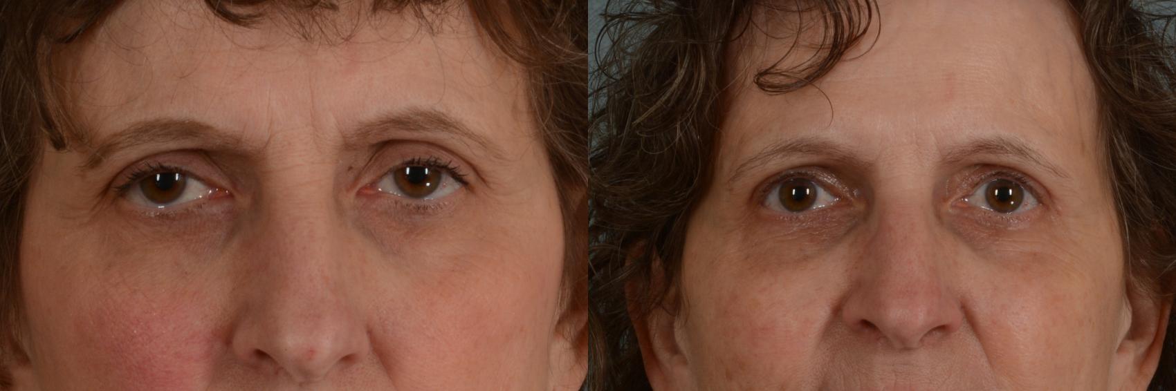 Before & After Oculoplastic Surgery Case 336 View #1 View in Tallahassee, FL