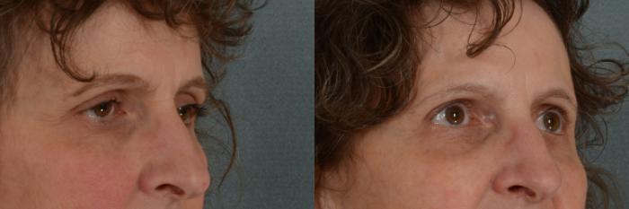 Before & After Oculoplastic Surgery Case 336 View #2 View in Tallahassee, FL