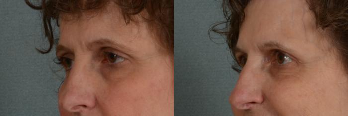 Before & After Oculoplastic Surgery Case 336 View #3 View in Tallahassee, FL