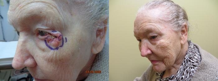 Before & After Oculoplastic Surgery Case 345 View #1 View in Tallahassee, FL