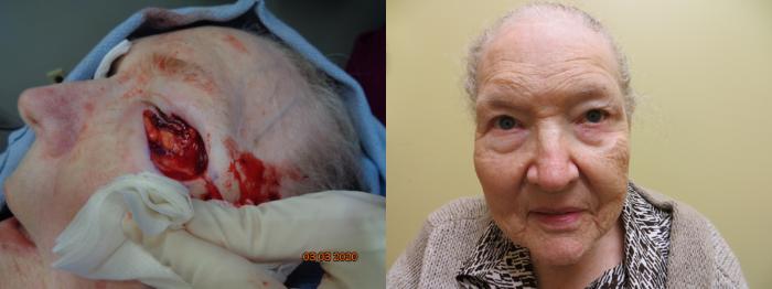 Before & After Oculoplastic Surgery Case 345 View #2 View in Tallahassee, FL