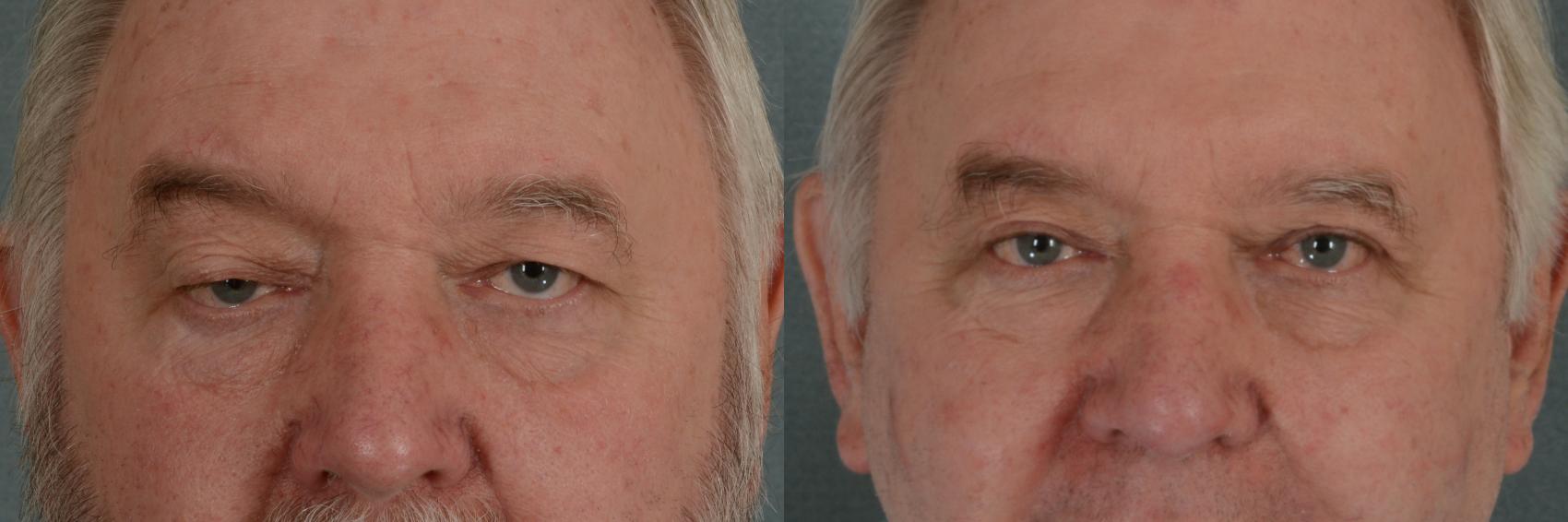 Before & After Oculoplastic Surgery Case 353 View #1 View in Tallahassee, FL