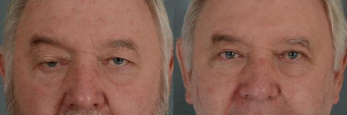 Before & After Oculoplastic Surgery Case 353 View #1 View in Tallahassee, FL