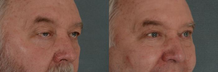 Before & After Oculoplastic Surgery Case 353 View #2 View in Tallahassee, FL
