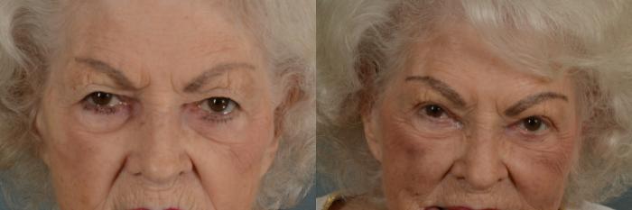 Before & After Oculoplastic Surgery Case 363 View #1 View in Tallahassee, FL