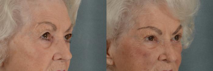 Before & After Oculoplastic Surgery Case 363 View #2 View in Tallahassee, FL