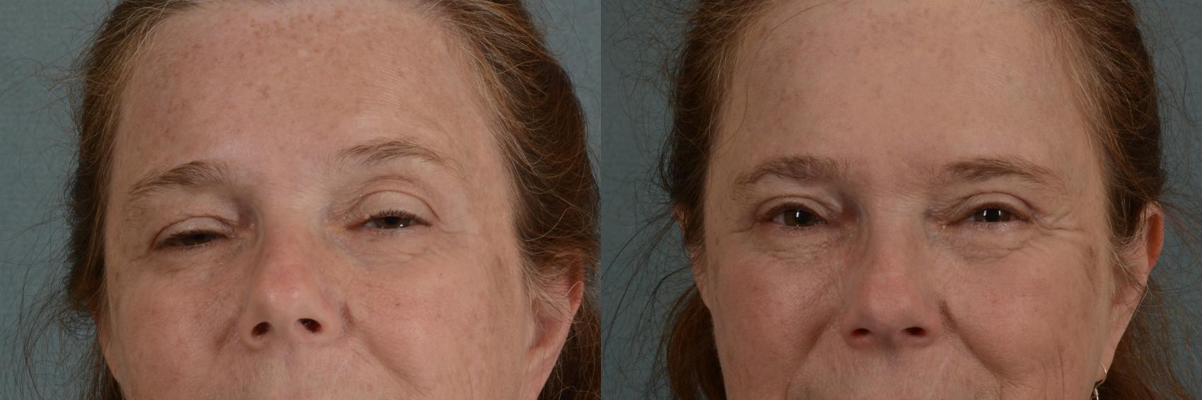 Before & After Oculoplastic Surgery Case 365 View #1 View in Tallahassee, FL