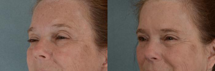 Before & After Oculoplastic Surgery Case 365 View #2 View in Tallahassee, FL
