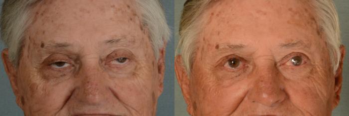 Before & After Oculoplastic Surgery Case 380 View #1 View in Tallahassee, FL