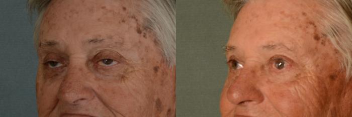 Before & After Oculoplastic Surgery Case 380 View #2 View in Tallahassee, FL