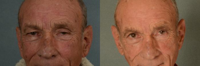 Before & After Oculoplastic Surgery Case 388 View #1 View in Tallahassee, FL