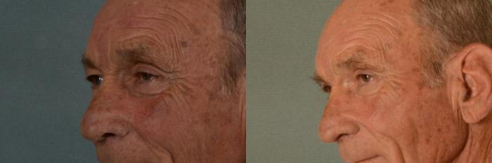 Before & After Oculoplastic Surgery Case 388 View #2 View in Tallahassee, FL